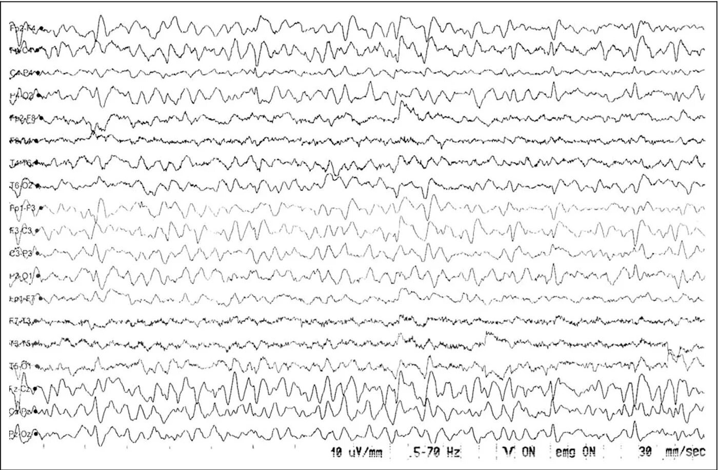 Эпилептиформная активность на ЭЭГ. Генерализованная эпилептиформная активность на ЭЭГ У ребенка. Доброкачественные эпилептиформные паттерны детства. Злокачественные мигрирующие парциальные приступы младенчества. Диффузная эпилептиформная активность