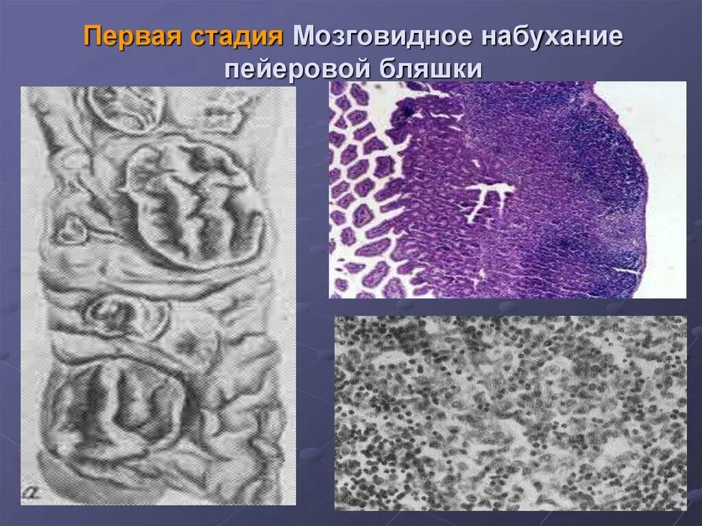 Мозговидное набухание пейеровых бляшек микропрепарат. Кишечные инфекции патологическая анатомия. Кишечные инфекции патологическая анатомия. Классификация кишечных инфекций патанатомия. Кишечные инфекции патологическая анатомия.