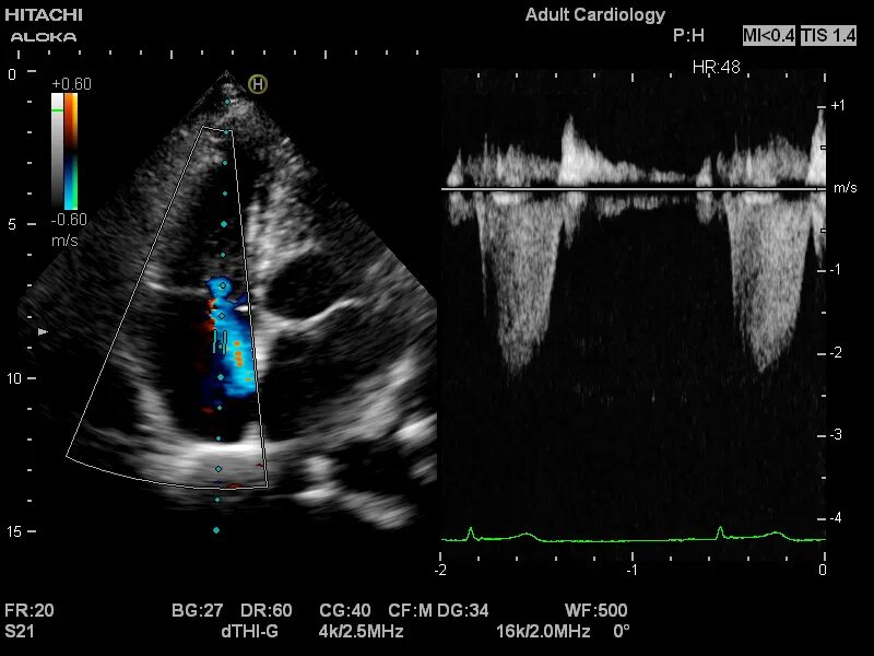 показатели эхокардиографии в норме у детей.
