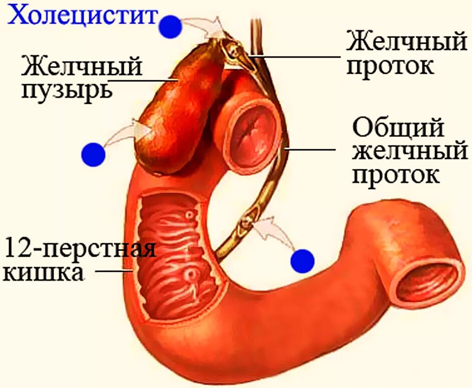 Хронический холецистит заболевания. Воспалительные заболевания желчного пузыря.