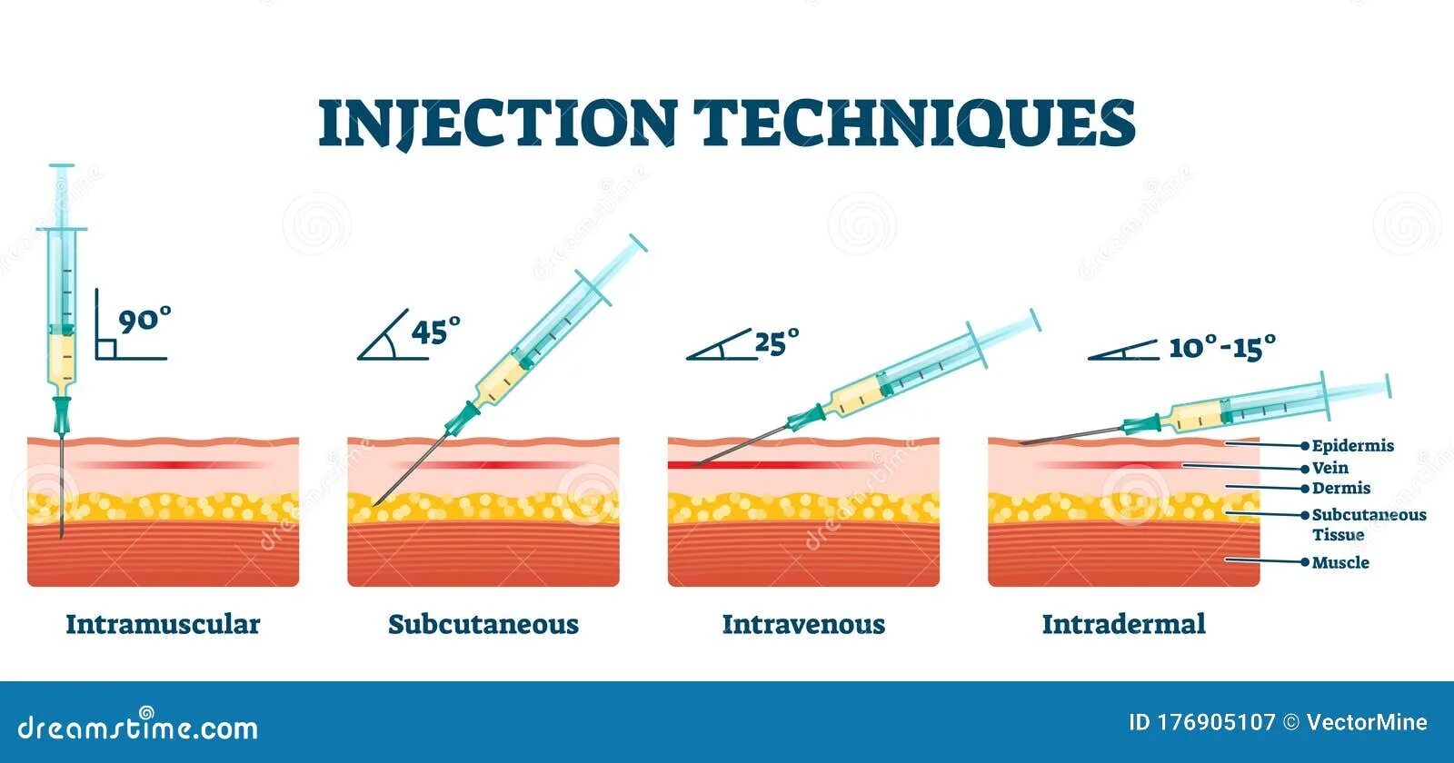 Градусы уколов. Интрадермальная инъекция. Подкожная и внутрикожная инъекция. Углы введения инъекций. Внутрикожные подкожные и внутримышечные инъекции.