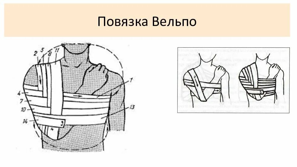 Плечевая повязка алгоритм. Повязка Вельпо техника наложения. Повязки Дезо и Вельпо алгоритм. Перевязка Вельпо алгоритм. Повязка Дезо и Вельпо.