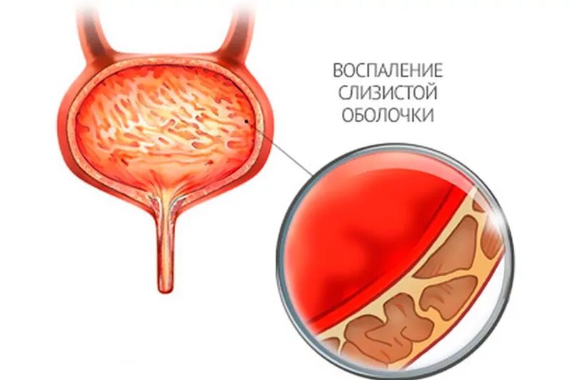 Цистит с кровью что делать