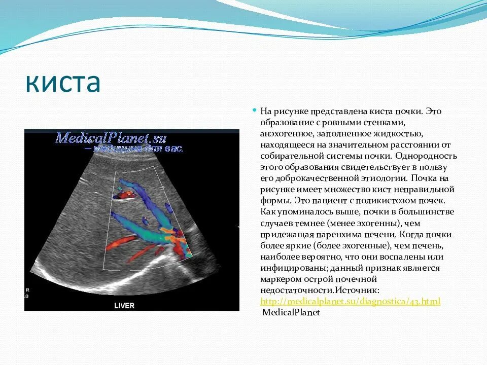 Что такое анэхогенное образование в почке