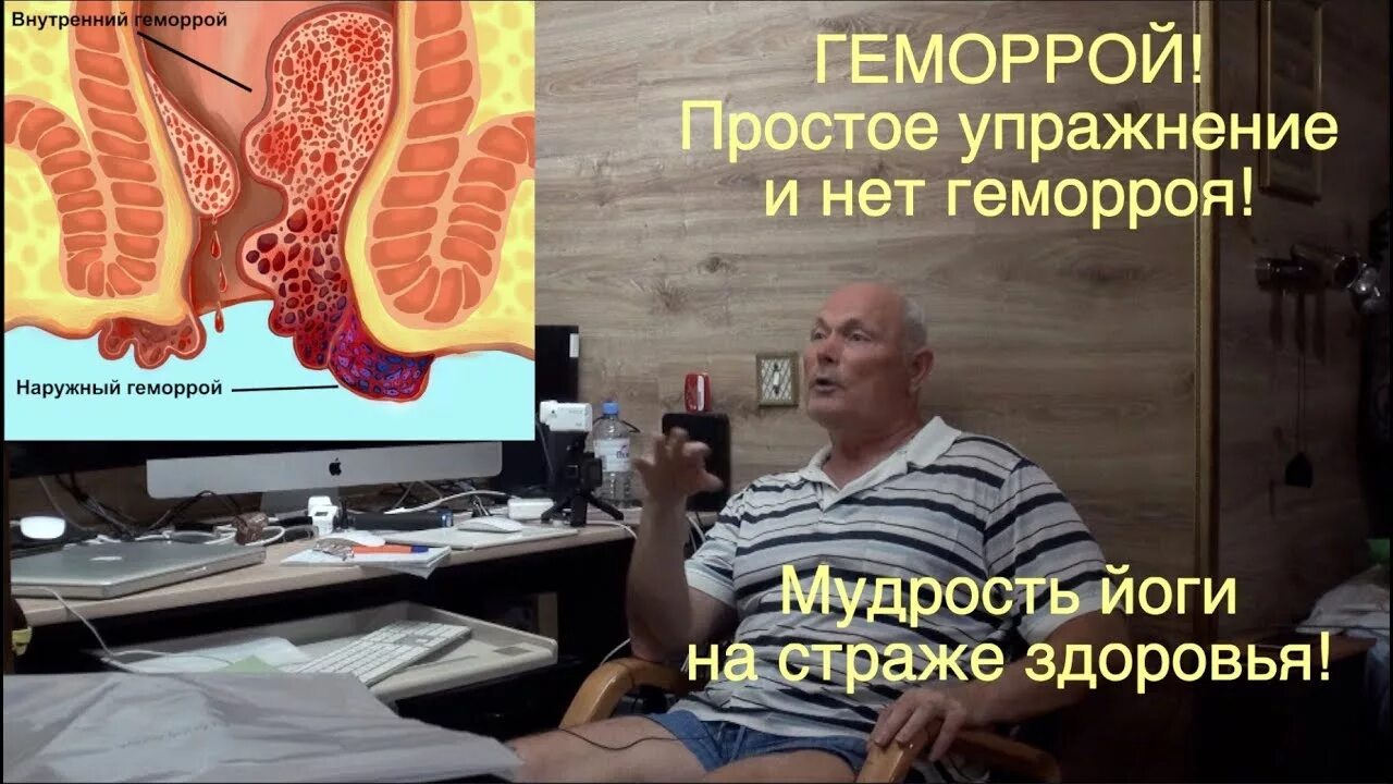 Упражнения оттгеммороя. Упражнения от геморроя. Упражнения для внешнего геморроя. Упражнения от геморроидальных узлов. Профилактика и лечение геморроя