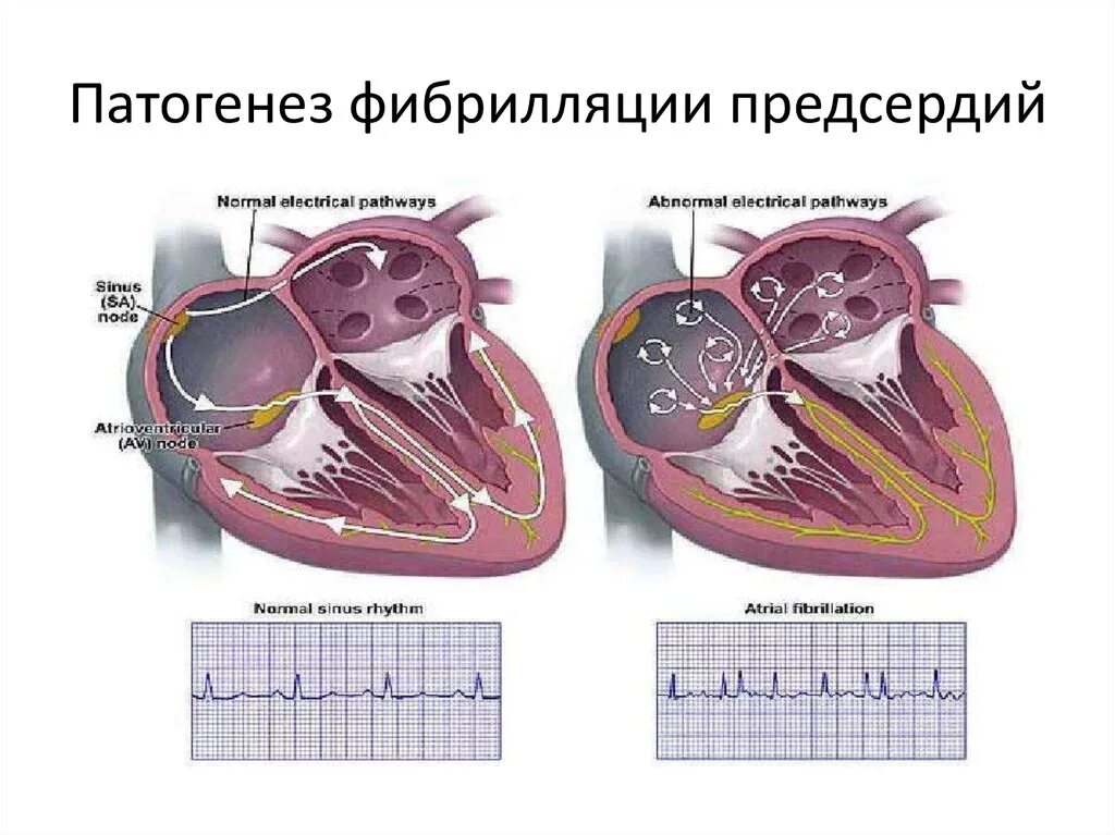 Механизм формирования фибрилляции предсердий. Трепетание предсердий механизм развития. Фибрилляция и трепетание предсердий патогенез. Механизм возникновения фибрилляции предсердий. Предсердие болезни