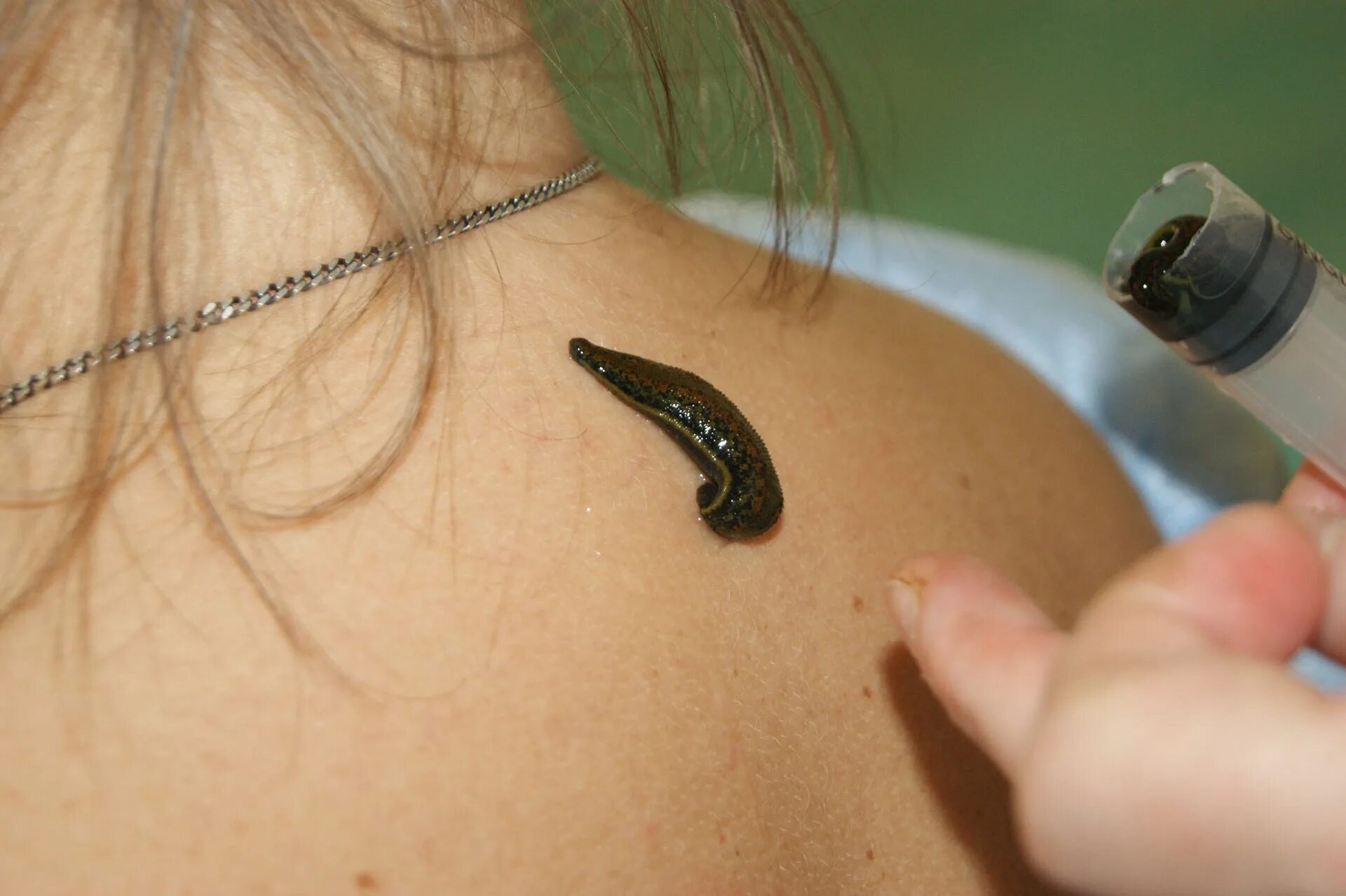 Гирудотерапия точки постановки. Лицо куда ставят пиявок. Гирудотерапия в косметологии. Постановка пиявок на голову схема. Пиявки при угревой сыпи.