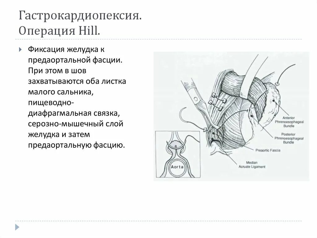 Операция томпсона. Лапароскопическая гастропексия. Тереспластика по Хиллу. Терес пластика по Хиллу. Диафрагмальная грыжа операция.