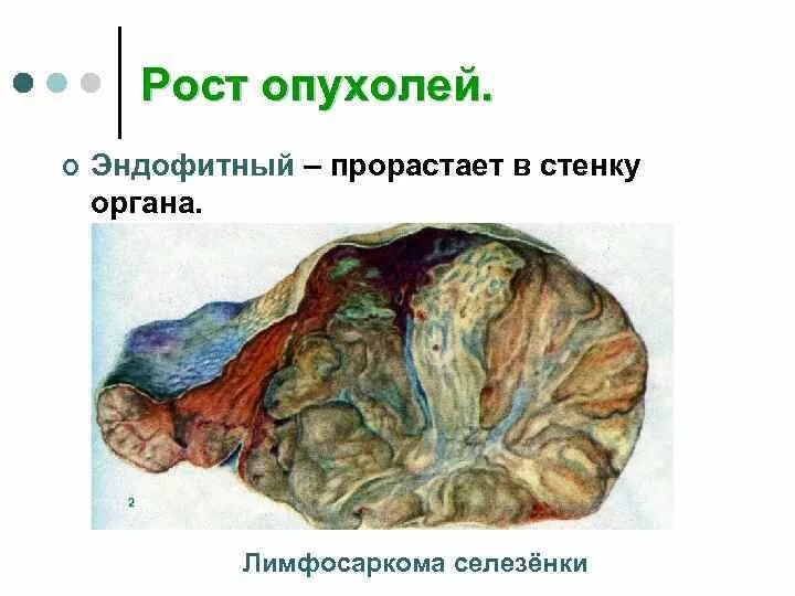 Типы роста опухолей. Эндофитный Тип роста опухоли. Строение опухоли. Эндофитный рост опухоли