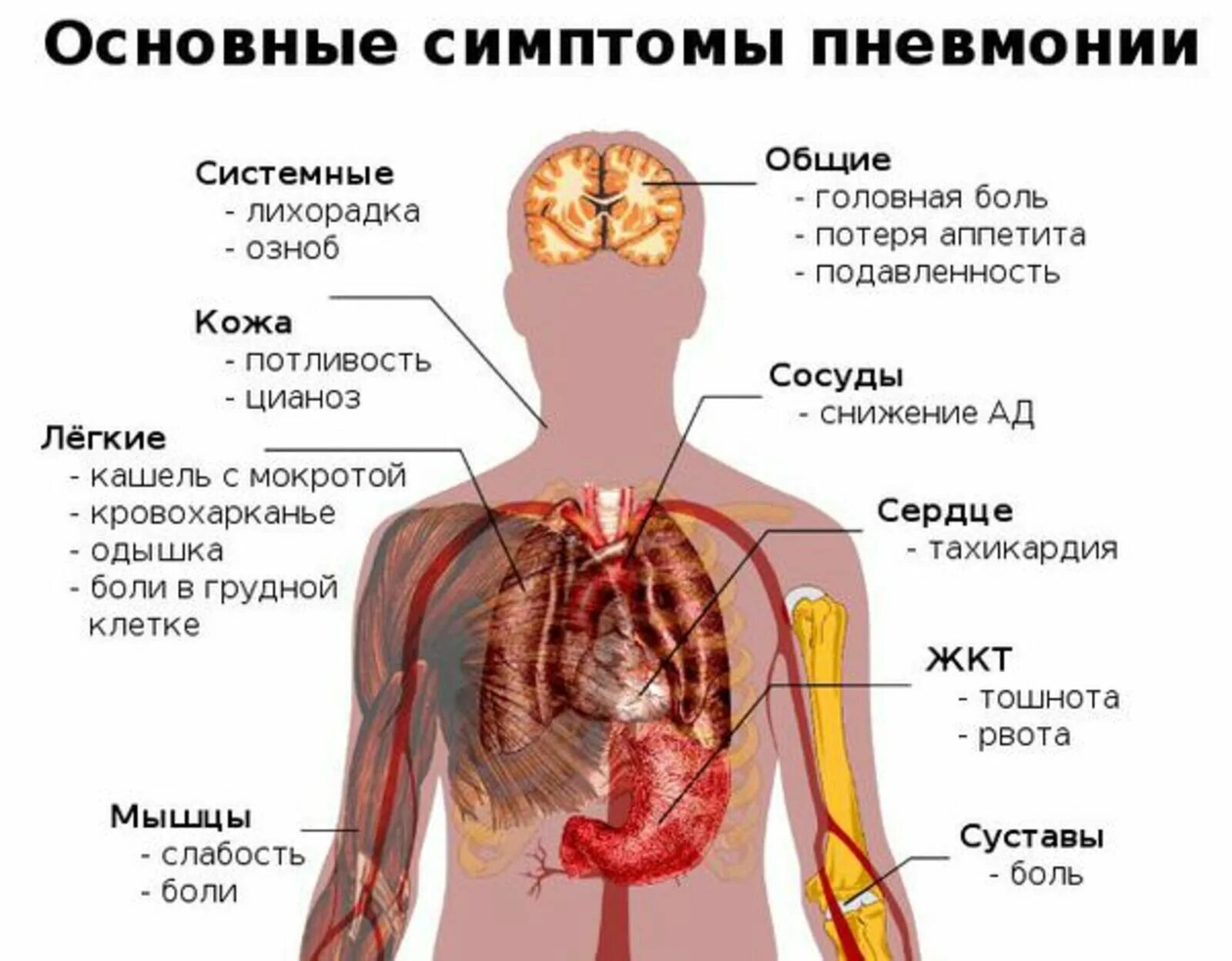 Воспаление лёгких симптомы. Воспаление лёгких симптомы у взрослых. Воспаление легких без температуры признаки у взрослого