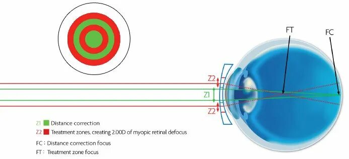 Линзы Cooper Vision MISIGHT. Mi Sight линзы. Контактные линзы MISIGHT 1 Day. Миопический дефокус. Линзы misight 1 купить