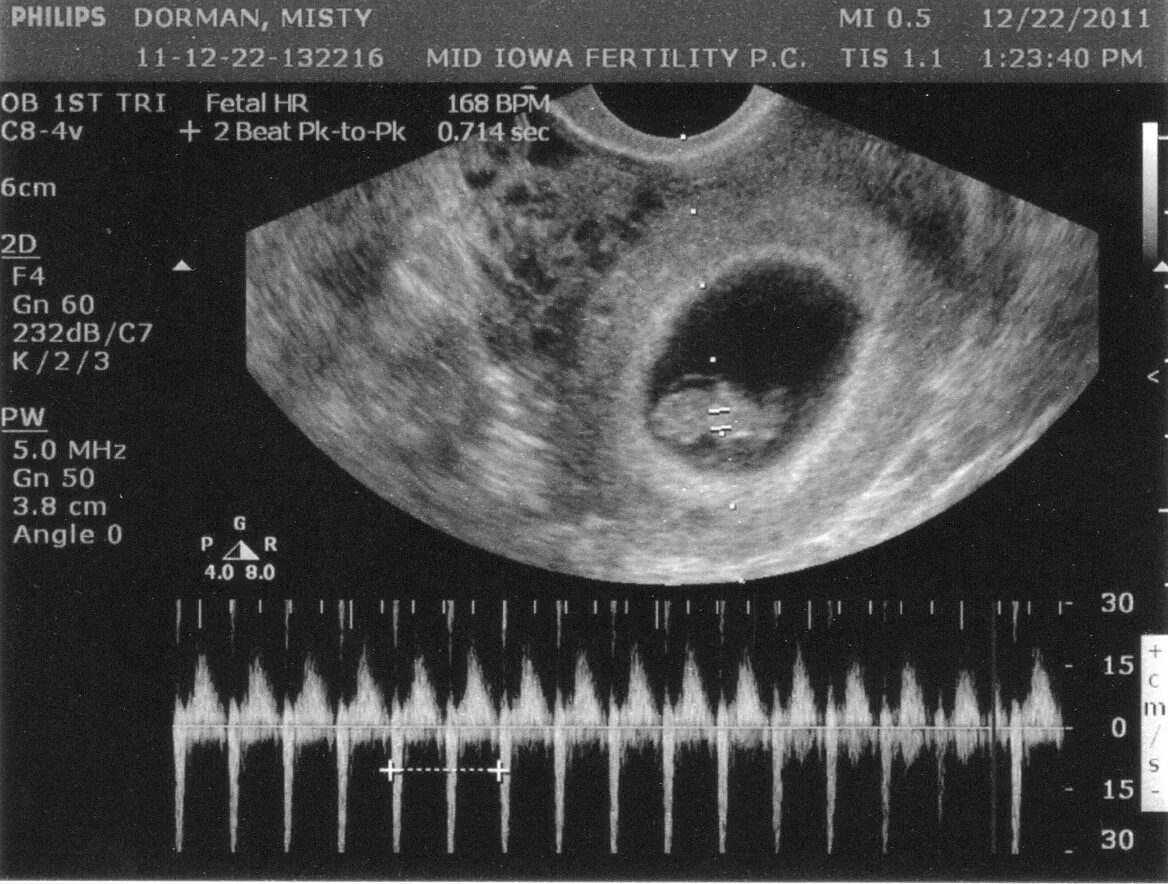 2 9 беременности. Размер плода на 8 неделе беременности. Размер эмбриона на 9 неделе. 9 Недель беременности размер плода. Размер эмбриона на 8 неделе.