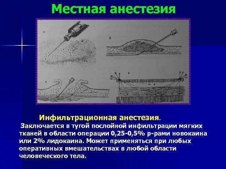 Проведение инфильтрационной анестезии. Инфильтрационная анестезия техника проведения. местная инфильтрационная анестезия методика. инфильтрационная анестезия оснащение. техника местной инфильтрационной анестезии.