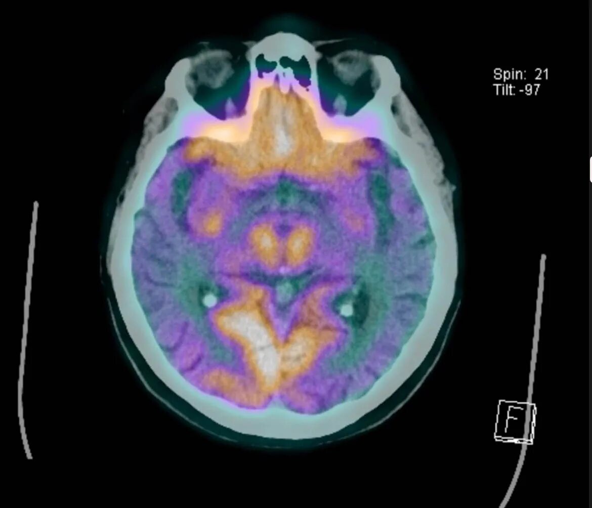 ПЭТ кт мозга. ПЭТ кт опухоли головного мозга. Накопление 252 % РФП ПЭТ кт. Рфп при пэт кт