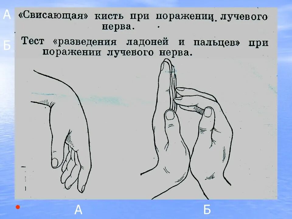 Поражение нервов руки. Поражение лучевого нерва. Свисающая кисть при поражении. Висячая кисть при поражении лучевого нерва. Положение кисти при поражении лучевого нерва.