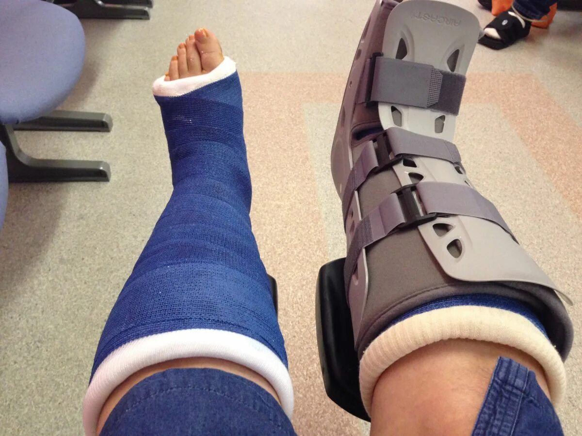 Broken my leg. Фото сломанной ноги девушки. My legs. Broken my leg. Break a leg.