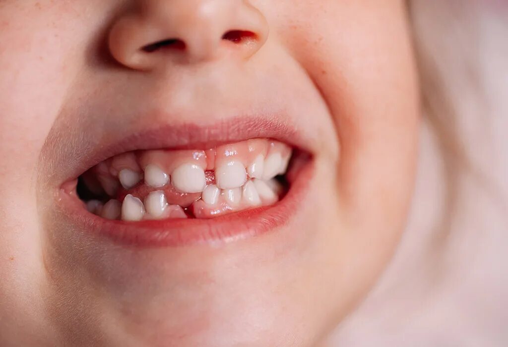 молочные зубы у детей. выпадение молочных зубов. коренные зубы у детей. выпадение молочных зубов. 5 лет выпал зуб нижний.