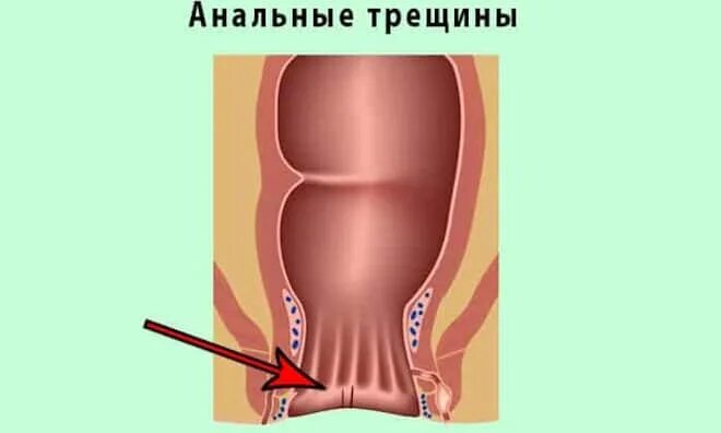 Можно ли в задний проход вставить