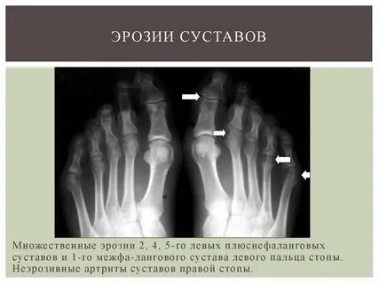 Эрозивный ревматоидный артрит