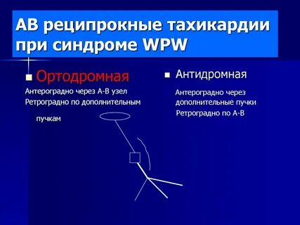 Реципрокная тахикардия