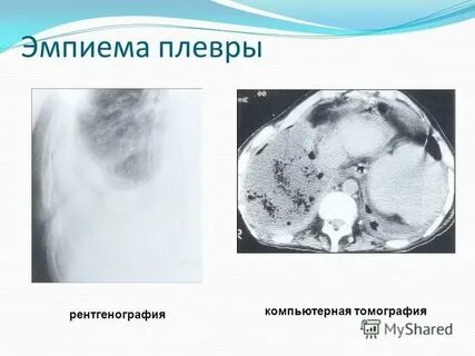 Эмпиема