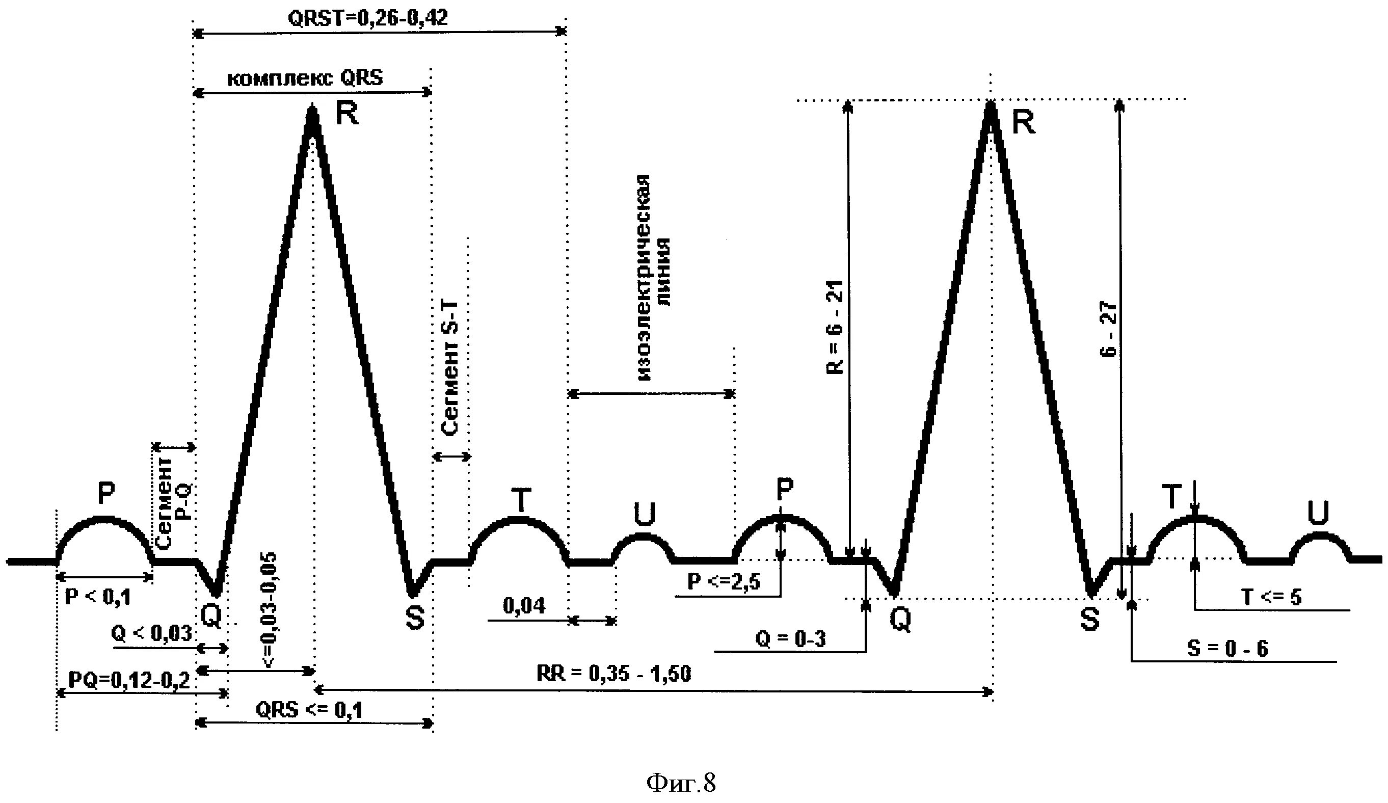 Нарастание зубца. Нормы длительности зубцов и интервалов ЭКГ. Продолжительность зубцов и интервалов ЭКГ В норме. Норма продолжительности зубцов на ЭКГ. QRS норма ЭКГ.