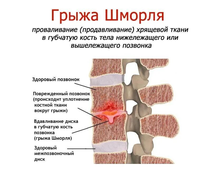 L1 грыжа Шморля позвоночника. Узлы Шморля рентген. Грыжа Шморля s1 s5 позвоночника. Th 12 грудного позвонка грыжа Шморля.