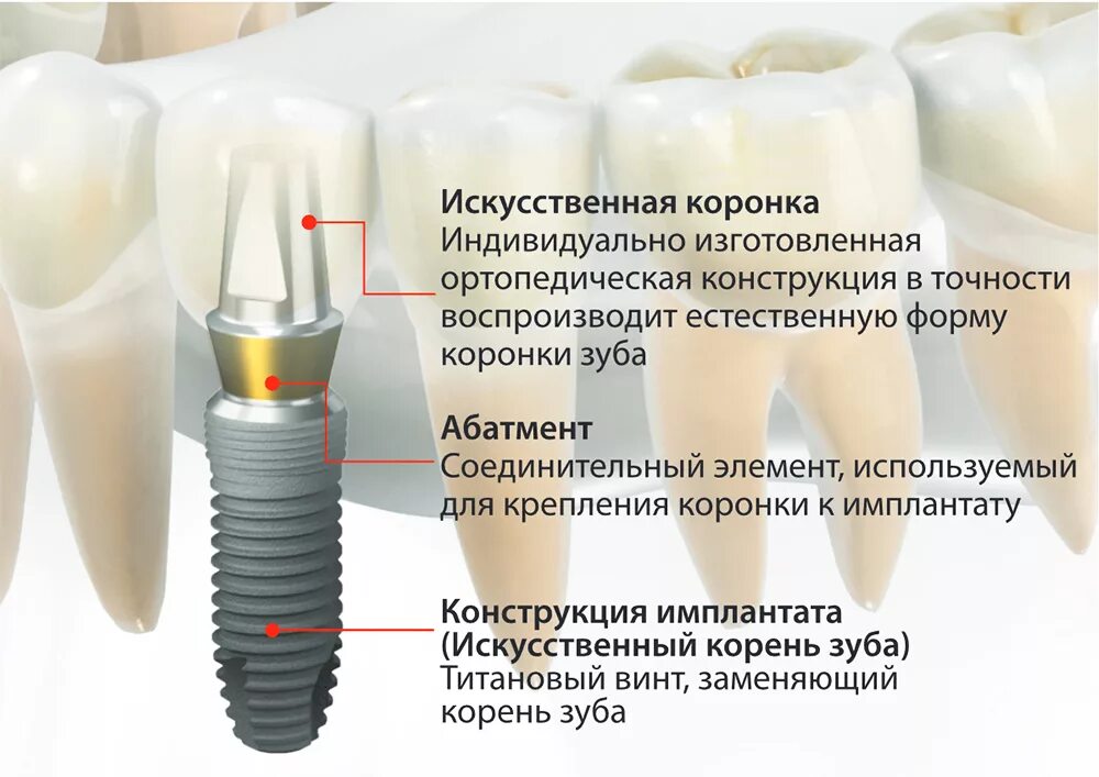 Зубы импланты поэтапно. Имплантация Implantium. Внутрикостные дентальные имплантаты. Импланты Дентиум 3412. Имплантация зубов внутрикостная дентальная имплантация.