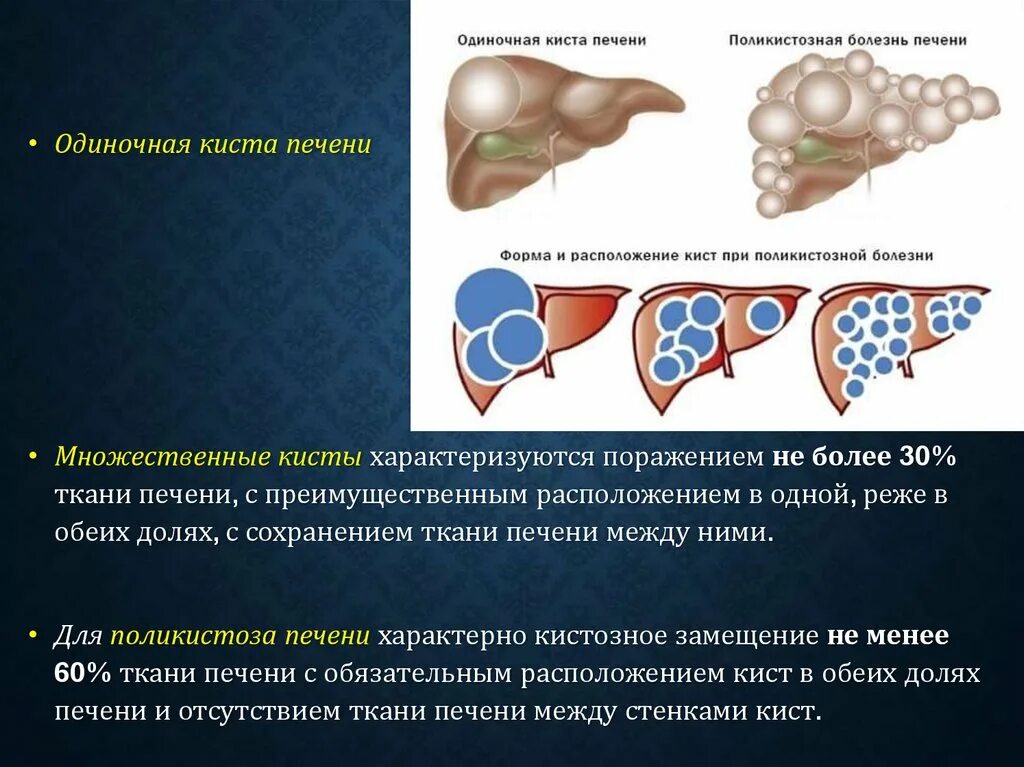 Киста на печени чем опасна у женщины