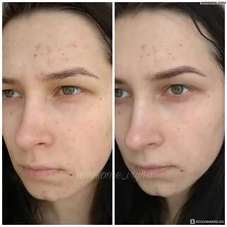 Как быстрее избавиться от прыщей