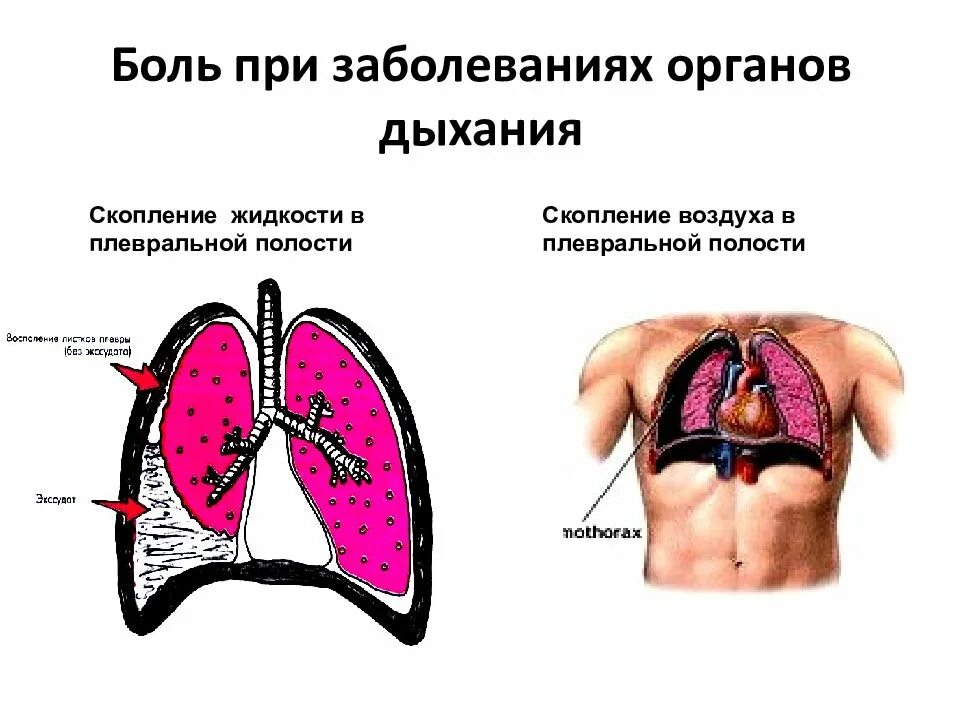 Скопление крови в плевральной полости. Скопление воздуха в плевральной полости. Болит легкое при вдохе. Плевральная боль в грудной клетке. Плевральная полость.