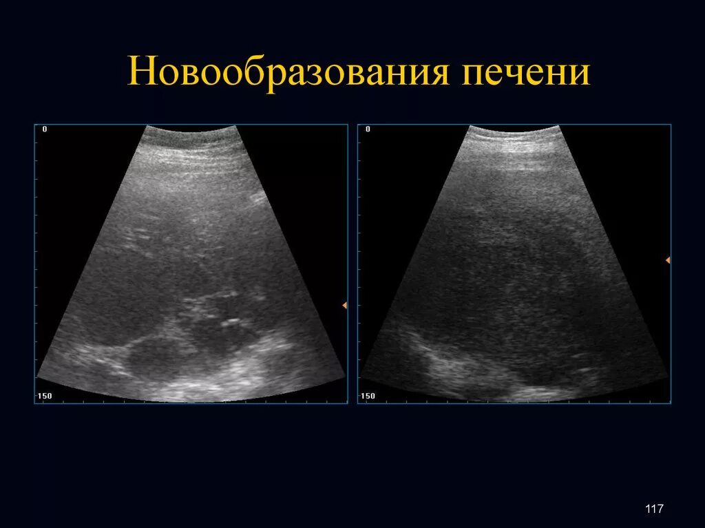 Объемные образования печени на УЗИ. Новообразование в печени на УЗИ.