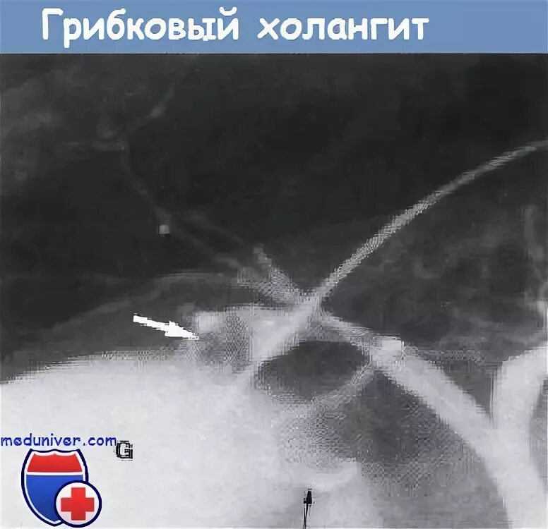 Холангит у кошек. Эндоскопическая ретроградная холангиография. Холангиография противопоказания. Холангиография код операции. Гангренозный холецистит фото.