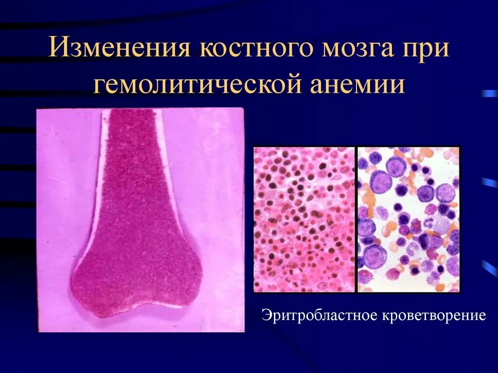 Изменения при анемии. Изменения в костном мозге при гемолитической анемии. патологии красного костного мозга. изменения в периферической крови при гемолитической анемии. мазок крови при гемолитической анемии.