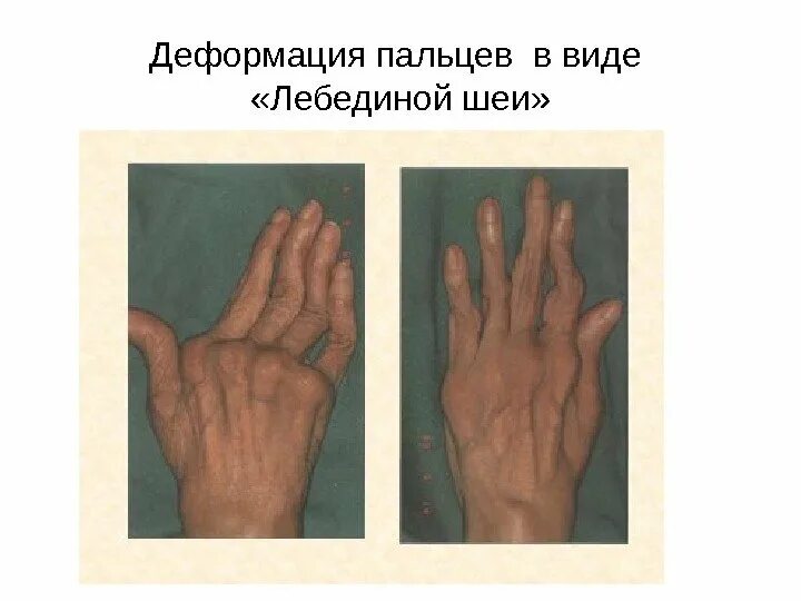 Деформации кисти при артритах. Ревматоидный артрит деформации. лебежиная шея ревматоидныйарторит. кисти с ревматоидным артритом бутоньерка. ревматоидный артрит деформация кисти.