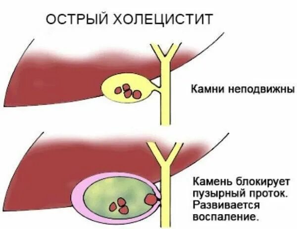 Хронический холецистит заболевания. Причины острого холецистита. Воспаление желчного пузыря. Острый холецистит желчного пузыря.