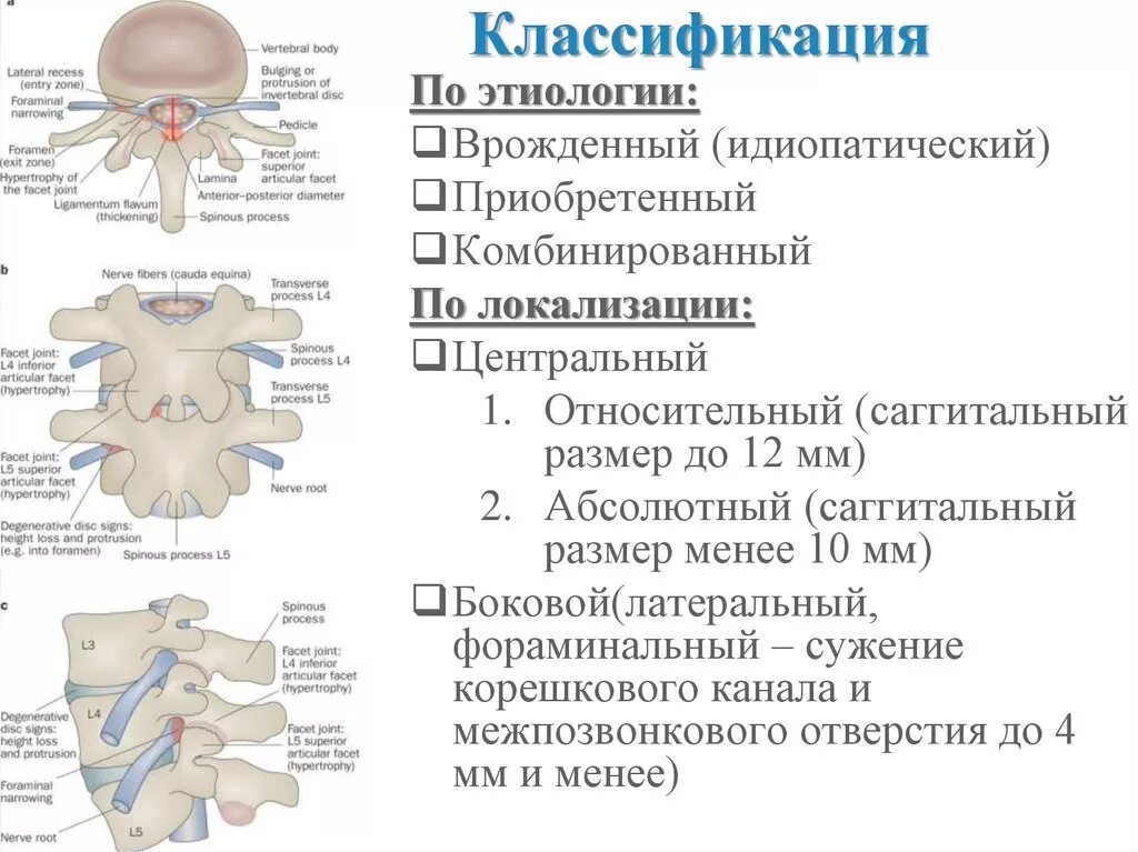 Поясничный абсолютный стеноз