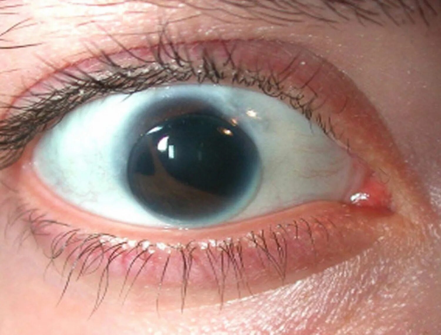 Поликория аномалия глаз. Поликория радужной оболочки.