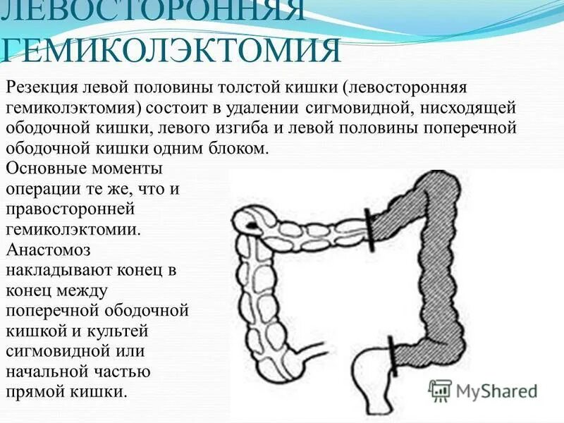 Ободочная и поперечно ободочная кишка. Отделы толстой кишки ободочная кишка. Обтурационная резекция сигмовидной кишки. Резекция сигмовидной кишки анастомоз.