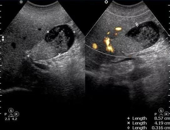 Опухоль желчного пузыря на УЗИ. УЗД опухолей желчного пузыря. УЗИ почек снимок. УЗИ снимки органов. На узи виден желудок