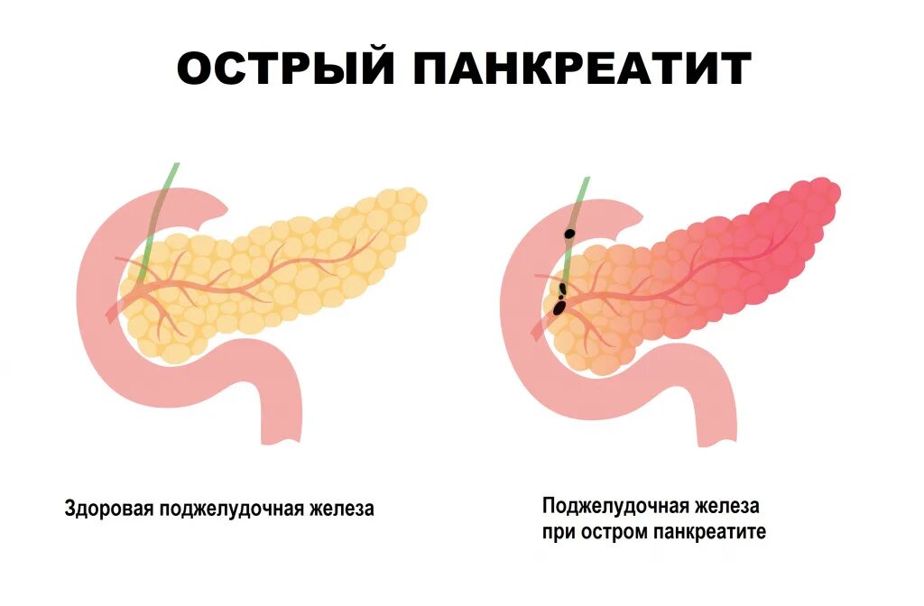 Панкреатит и язва желудка. Болит поджелудочная железа. Прободная язва поджелудочной железы. Симптомы раздражения брюшины при панкреатите.