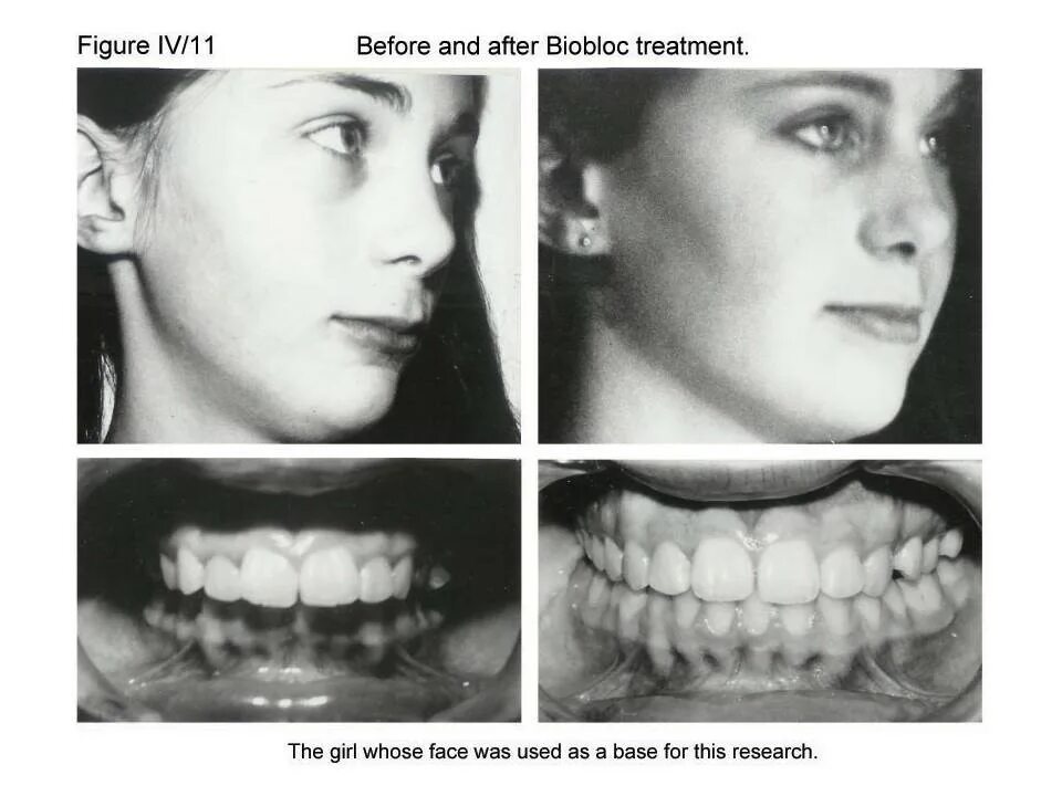 ортодонт мезиальный прикус. мезиальный прикус и внчс. рахитический открытый прикус. мезиальный прикус нижней челюсти. строение челюсти прогения прогнатия.