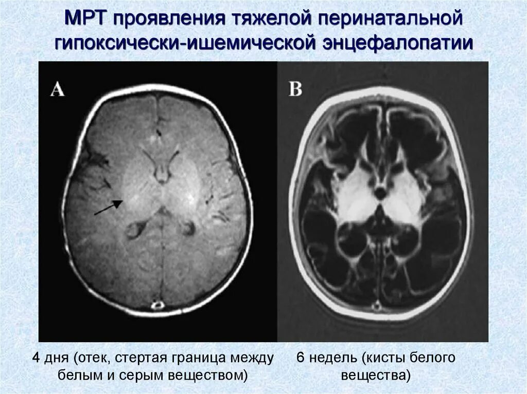 Гипоксически-ишемическая энцефалопатия кт. Гипоксически-ишемическое поражение головного мозга кт. Гипоксическая ишемическая энцефалопатия новорожденного. Гипоксическая энцефалопатия на мрт.