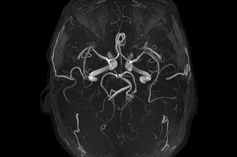 Сосуды головного мозга норма. Магнитно-резонансная ангиография артерий головного мозга. Кт ангиография головного мозга. СКТ-ангиография сосудов головного мозга. Кт ангиография сосудов головного мозга.