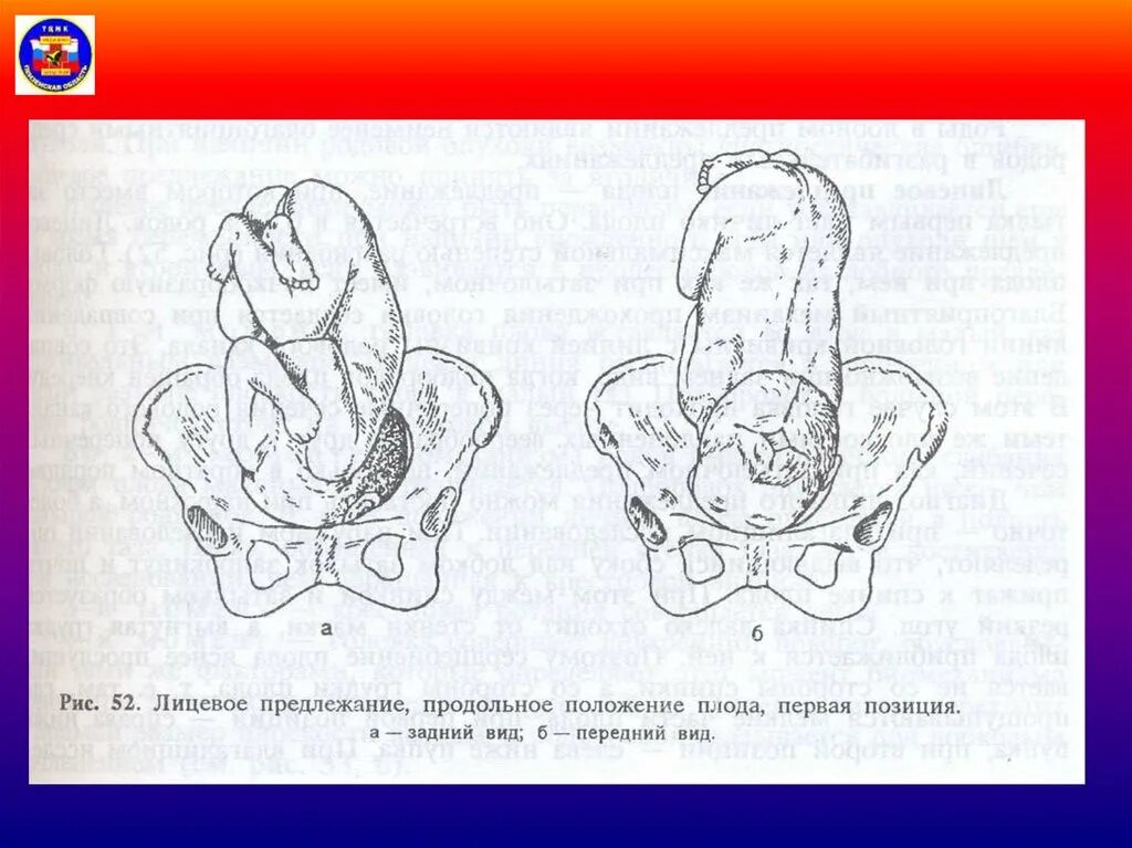 Предлежание 1 позиция. Головное предлежание продольное положение 1 позиция. Головное предлежание 2 позиция передний вид. Продольное головное предлежание 2 позиция. Головное предлежание 1 позиция передний вид.