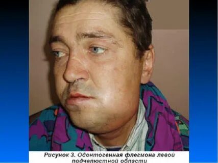 Флегмона новорожденных