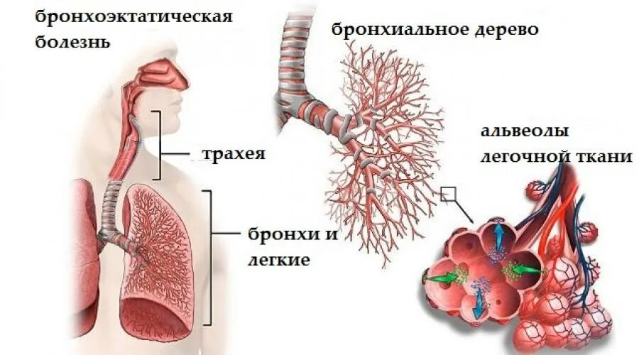 Легкие при сильном кашле. ФБС бронхоэктатическая болезнь. Бронхиальное дерево мокрота. Расширение мелких бронхов.