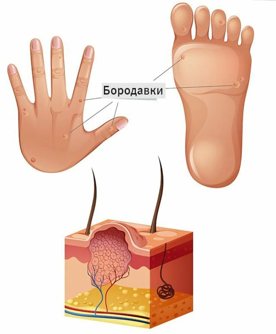 Корешочек. Подкожная подошвенная бородавка. ВПЧ бородавка подошвенная бородавка.
