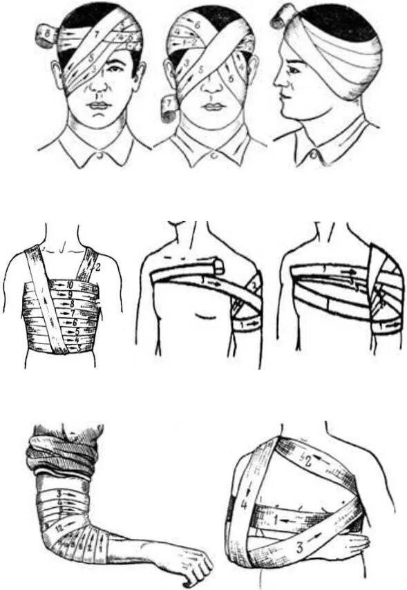 Как перевязывать голову. Повязки десмургия хирургия. Косыночная повязка на молочную железу. Повязки на туловище десмургия. Наложение косыночной повязки на верхнюю конечность.