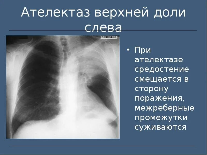 Обтурационный ателектаз легкого. Ателектаз доли рентген. Ателектаз сегментарный на рентгенограмме. Ателектаз s5 левого легкого. Компрессионный ателектаз лёгкого.